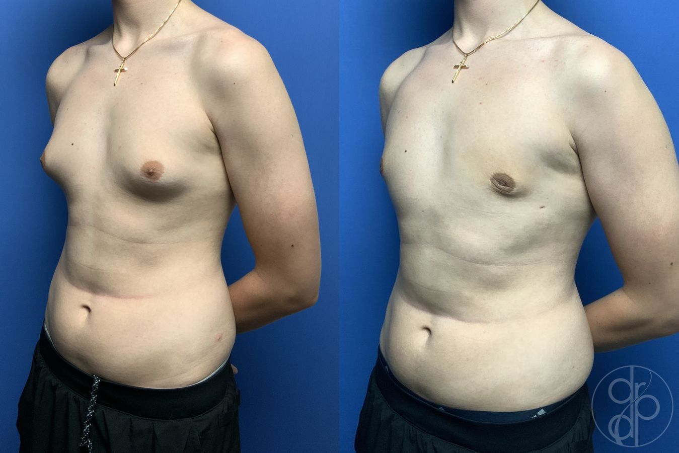 Gynecomastia - Thumbnail 3