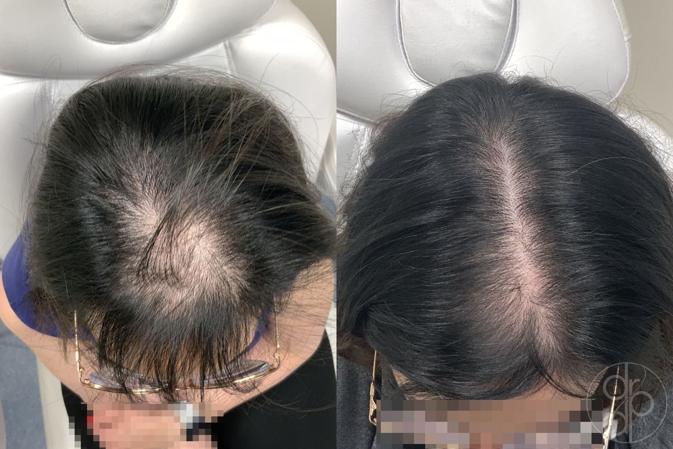 Hair Loss Treatment - Case 587