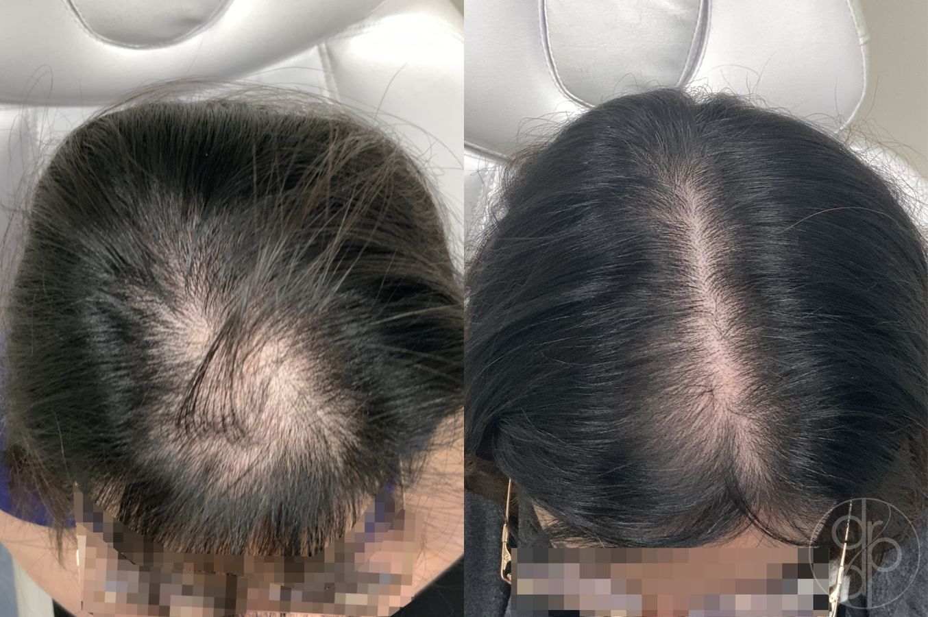 Before and after Hair Loss Treatment case 29904
