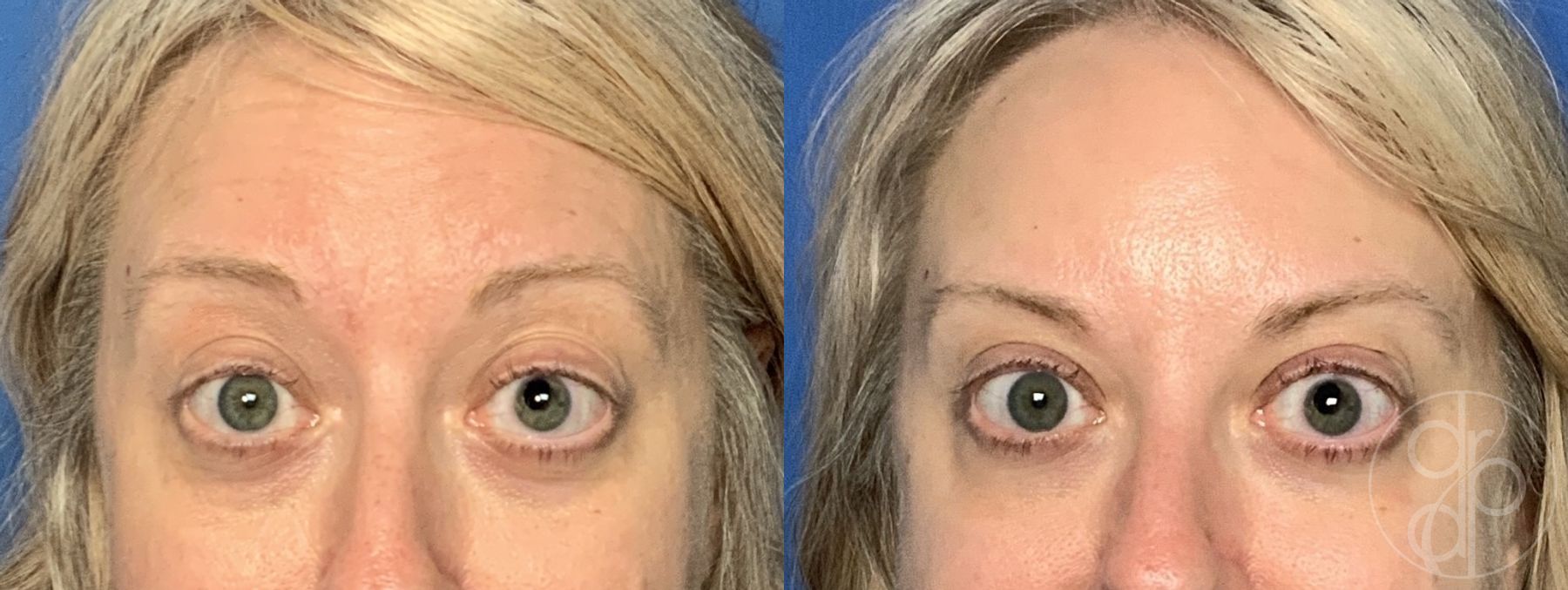 Before and after Injectables case 29963 - Angle 2