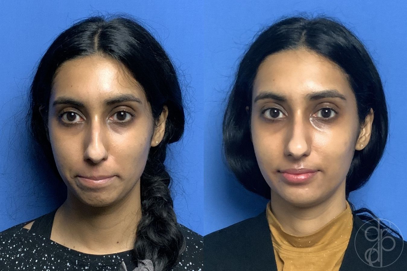 Before and after Injectables case 29966