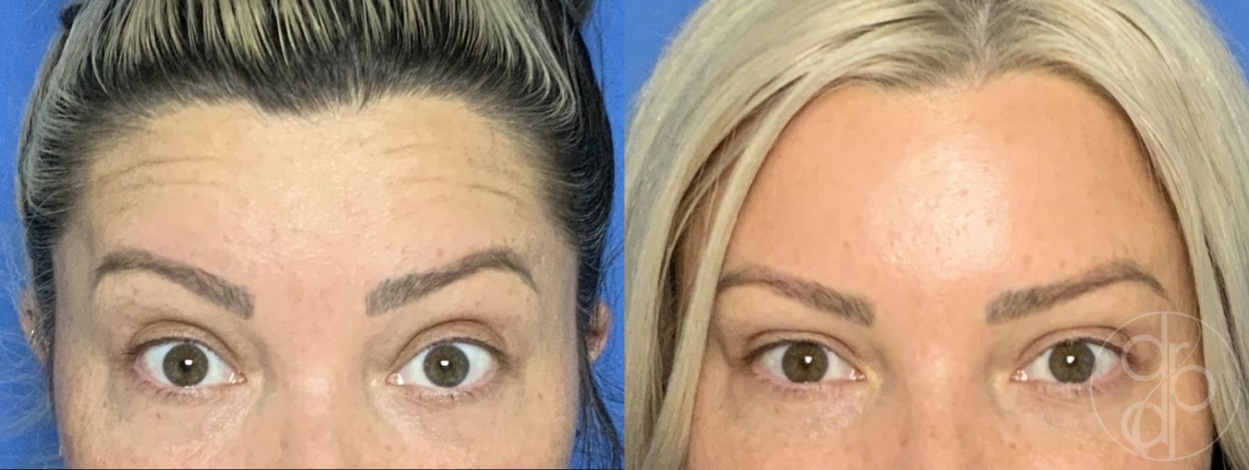 Before and after Injectables case 29903 - Angle 2