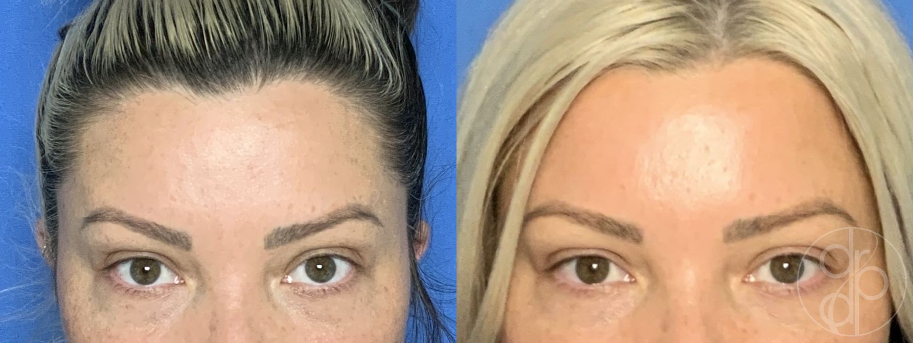 Before and after procedure result