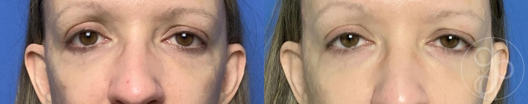 Before and after procedure result