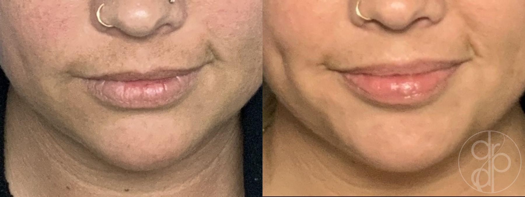 Before and after Injectables case 29903 - Angle 4