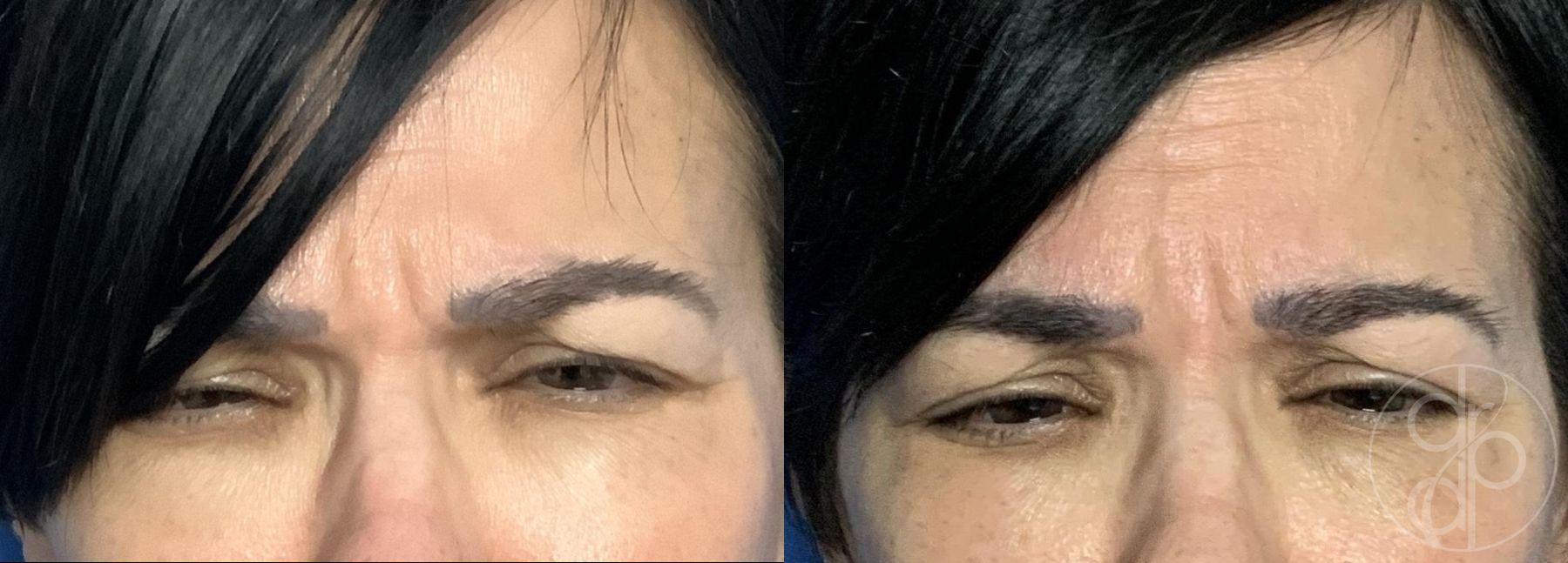 Before and after Injectables case 29756