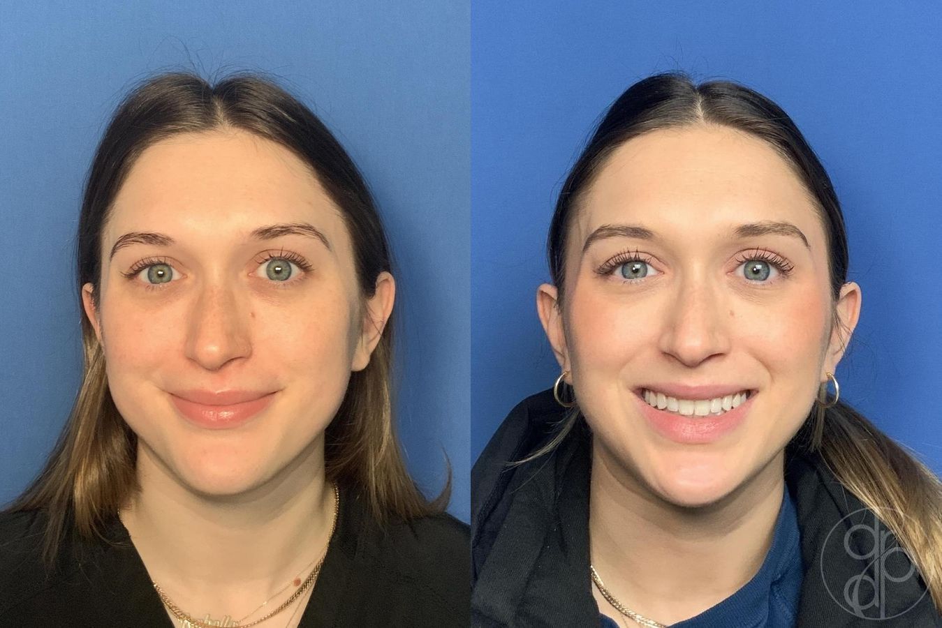 Before and after Injectables case 29984 - Angle 2