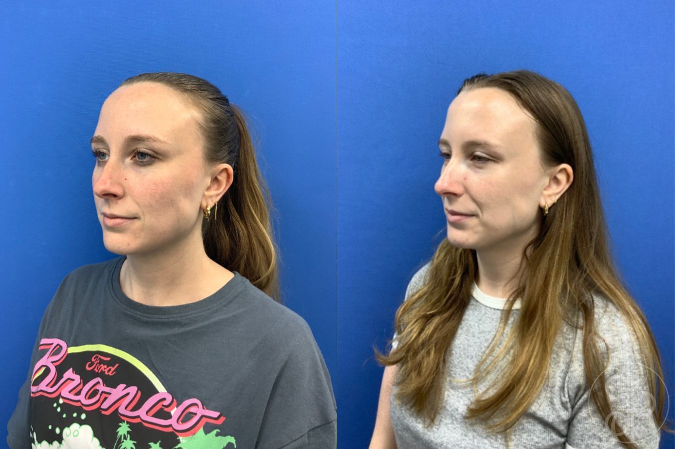 Before and after Injectables case 49449 - Angle 6