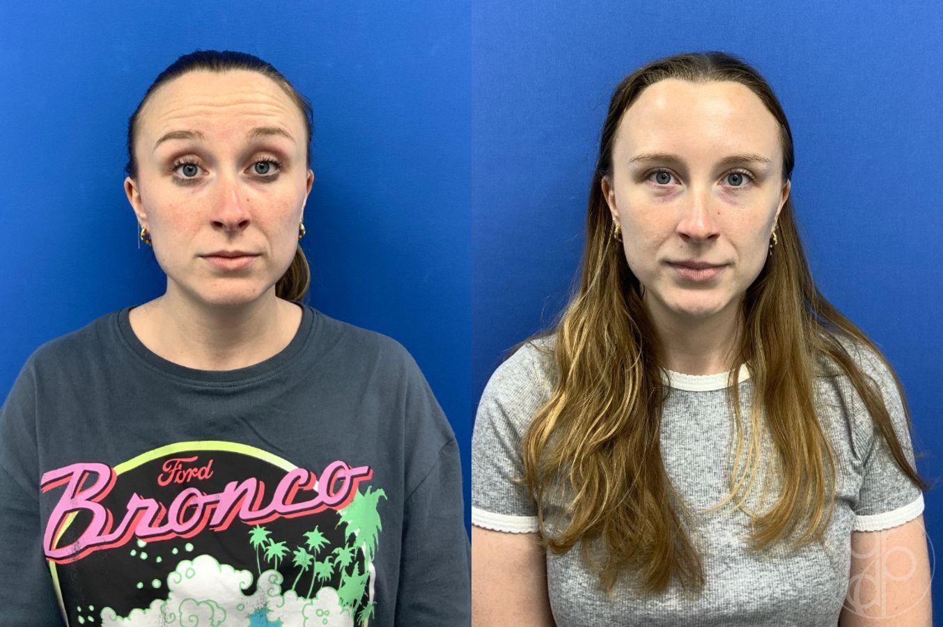Before and after Injectables case 49449 - Angle 3