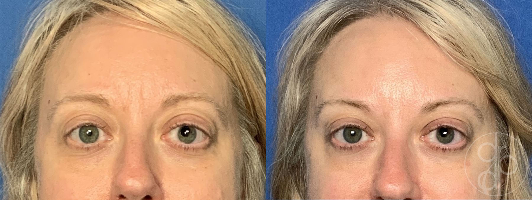 Before and after procedure result