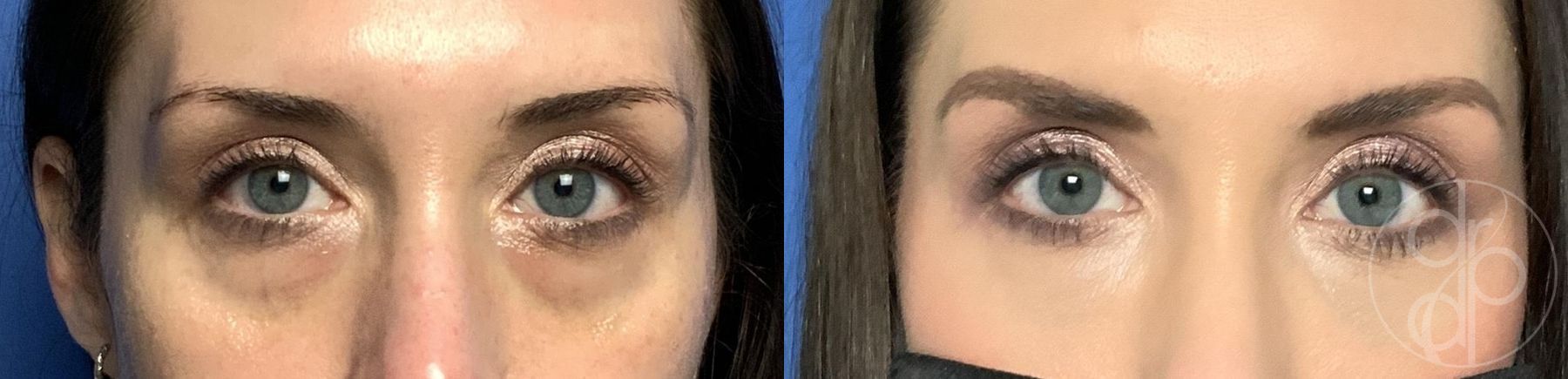 Before and after procedure result