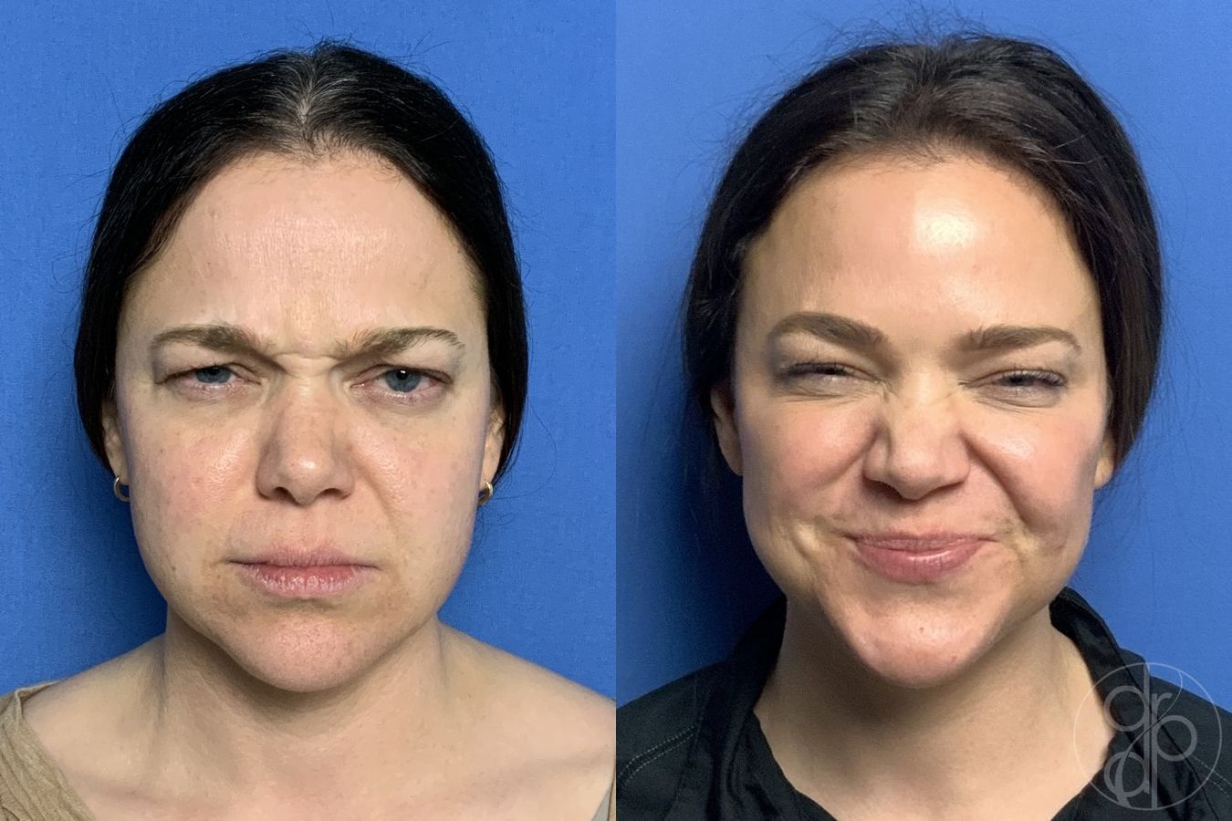 Before and after Fillers case 29977 - Angle 4