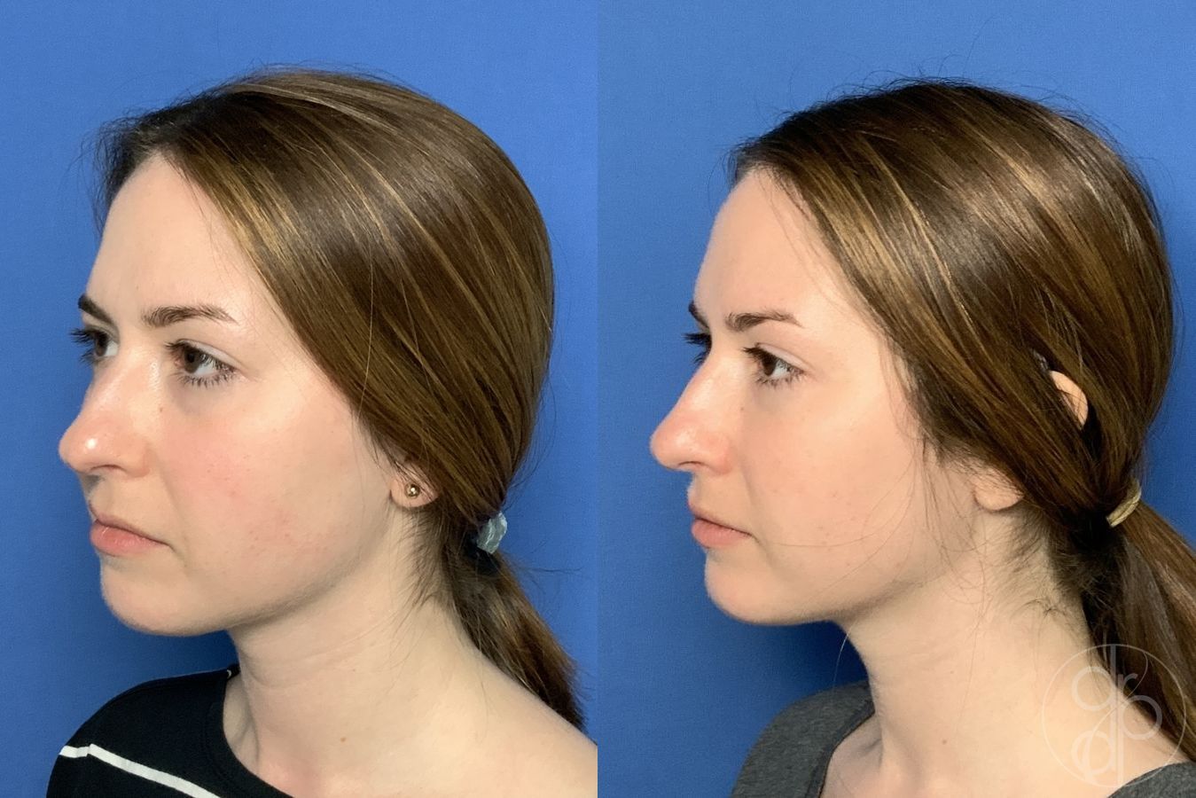 Before and after Injectables case 29969 - Angle 2