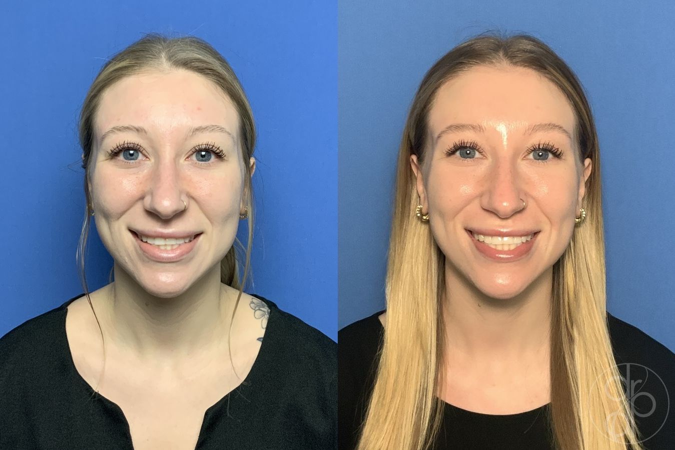 Before and after Injectables case 29980