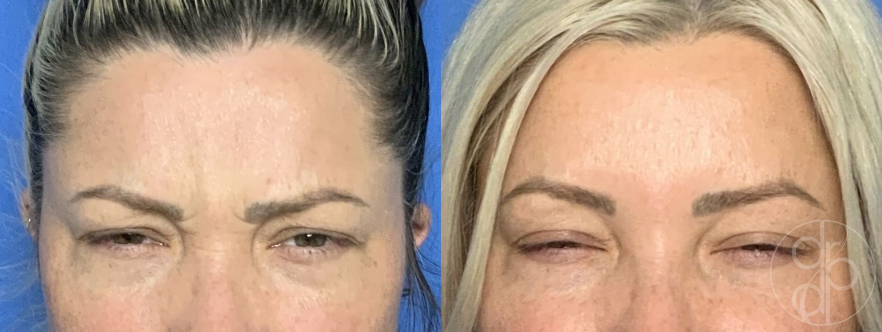 Before and after Injectables case 29903 - Angle 3