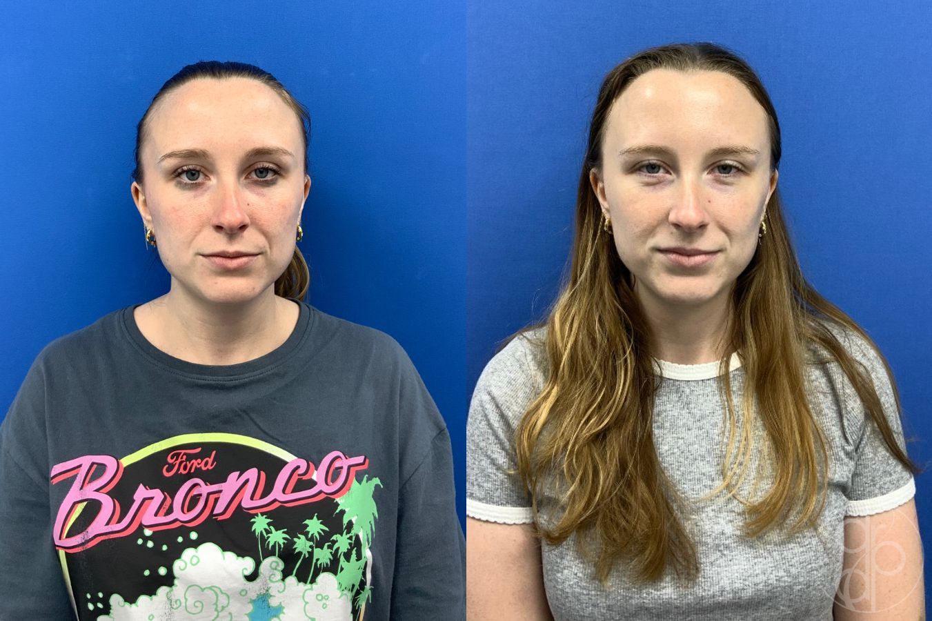 Before and after Injectables case 49449