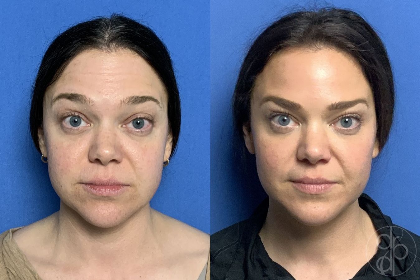 Before and after Fillers case 29977 - Angle 3