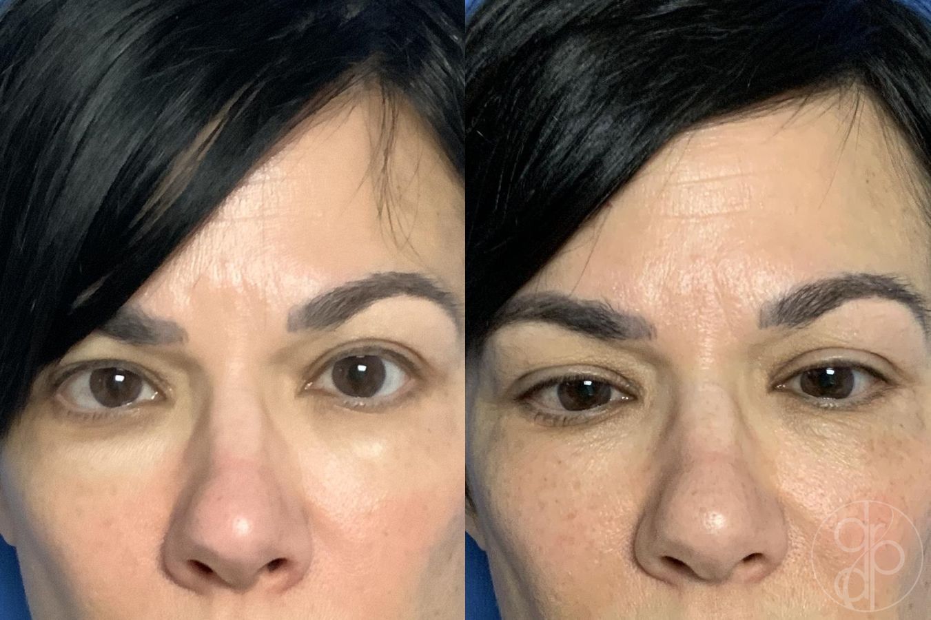 Before and after Injectables case 29756 - Angle 3