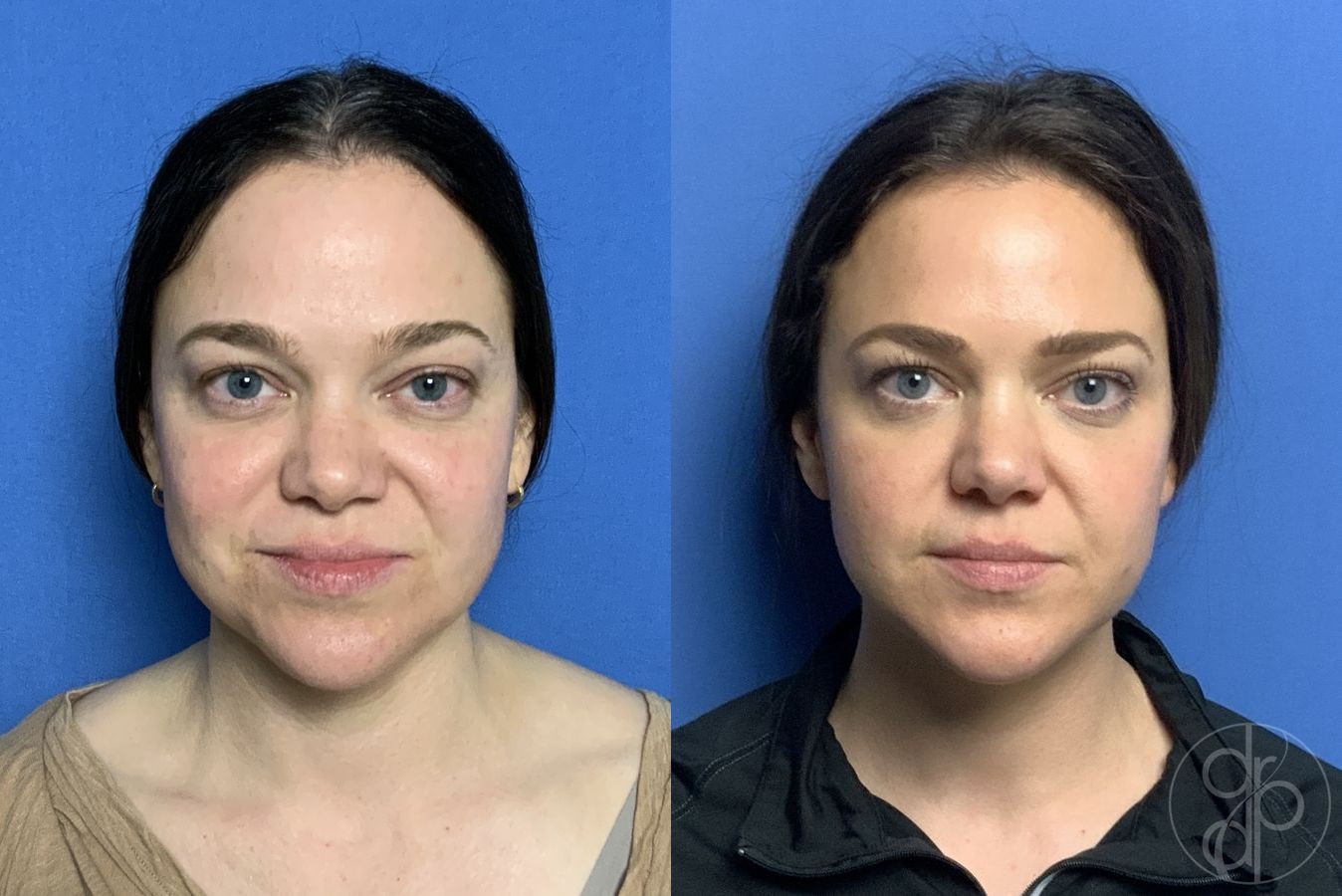 Before and after Fillers case 29977