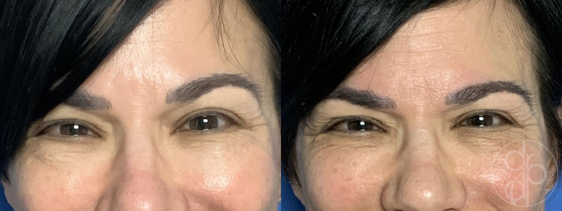 Before and after Injectables case 29756 - Angle 2