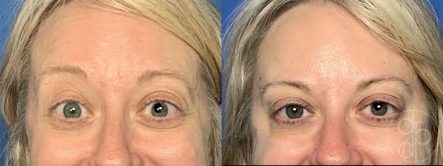 Before and after Injectables case 29963 - Angle 4