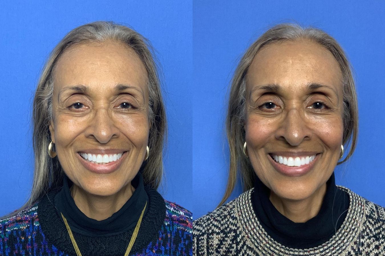 Before and after Injectables case 29987