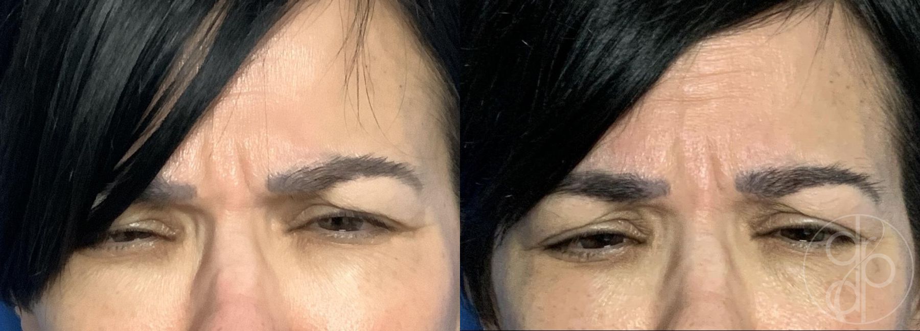 Before and after Injectables case 29756