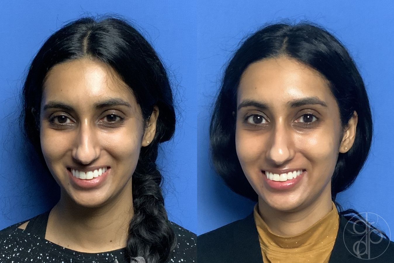Before and after Injectables case 29966 - Angle 2