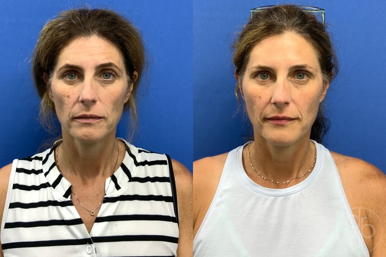 Before and after Injectables case 46747