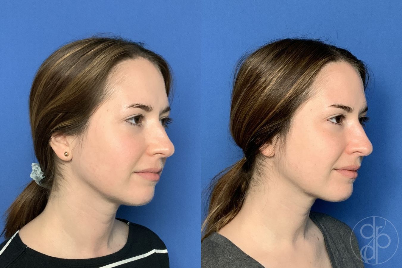 Before and after Injectables case 29969 - Angle 3