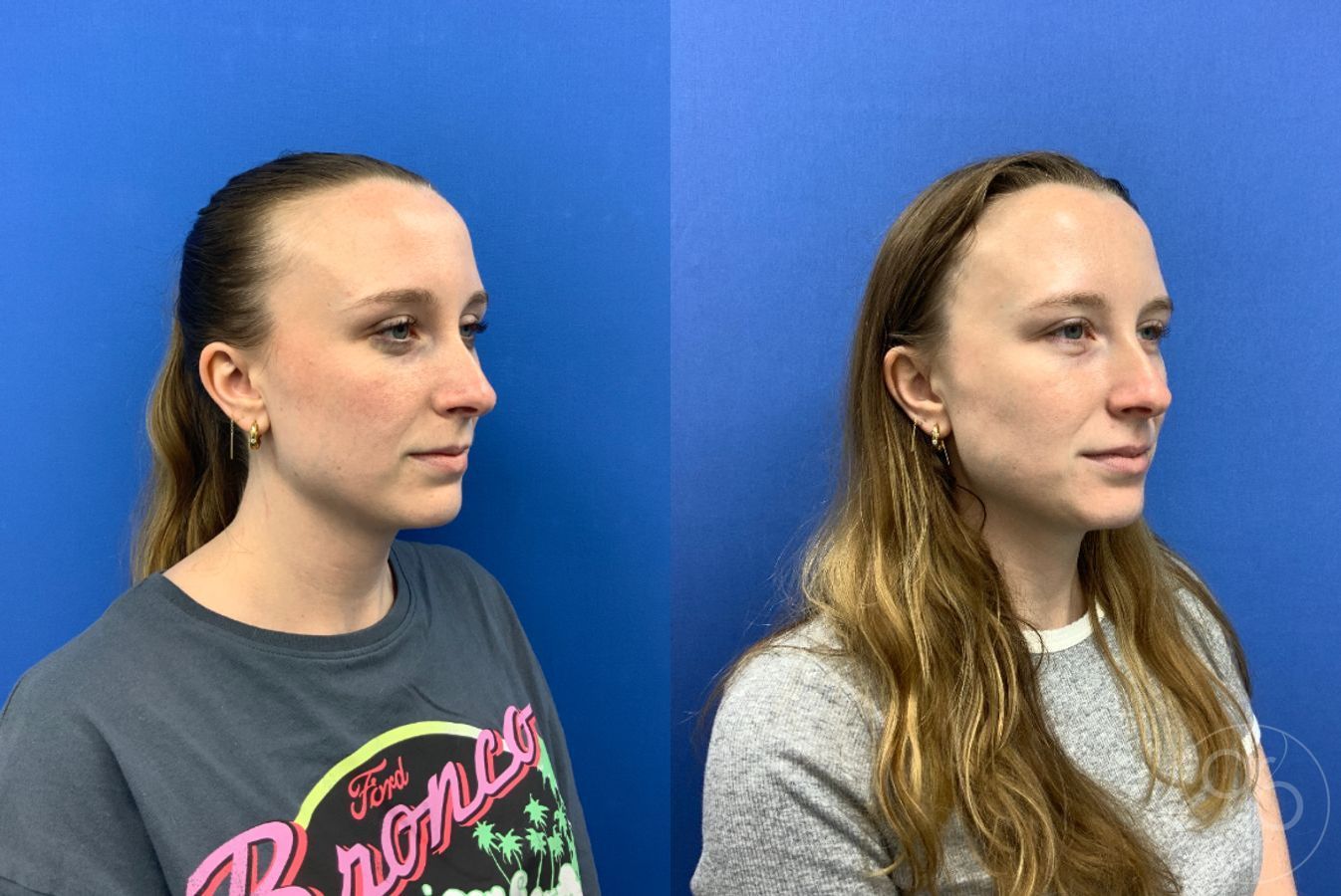 Before and after Injectables case 49449 - Angle 5