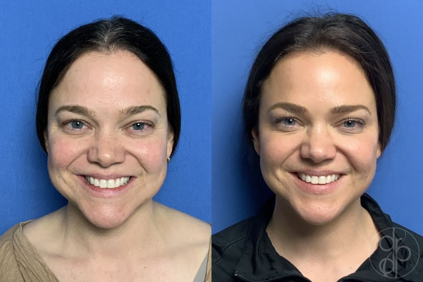 Before and after Fillers case 29977 - Angle 2