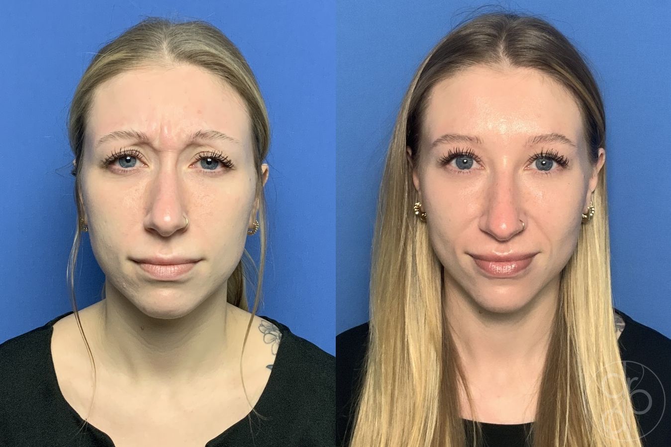 Before and after Injectables case 29980 - Angle 3