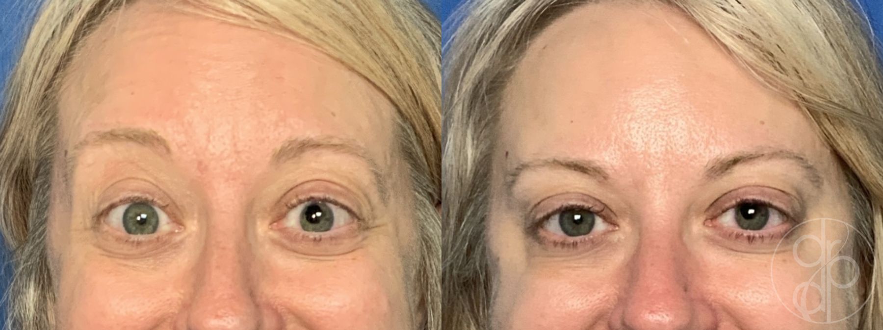 Before and after Injectables case 29963 - Angle 4