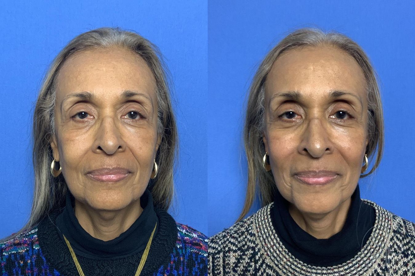Before and after Injectables case 29987 - Angle 2