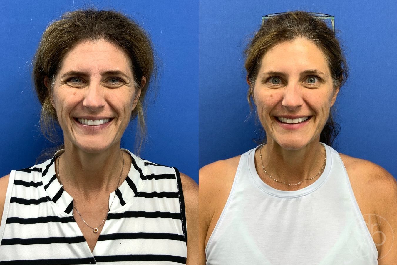 Before and after Injectables case 46747 - Angle 2