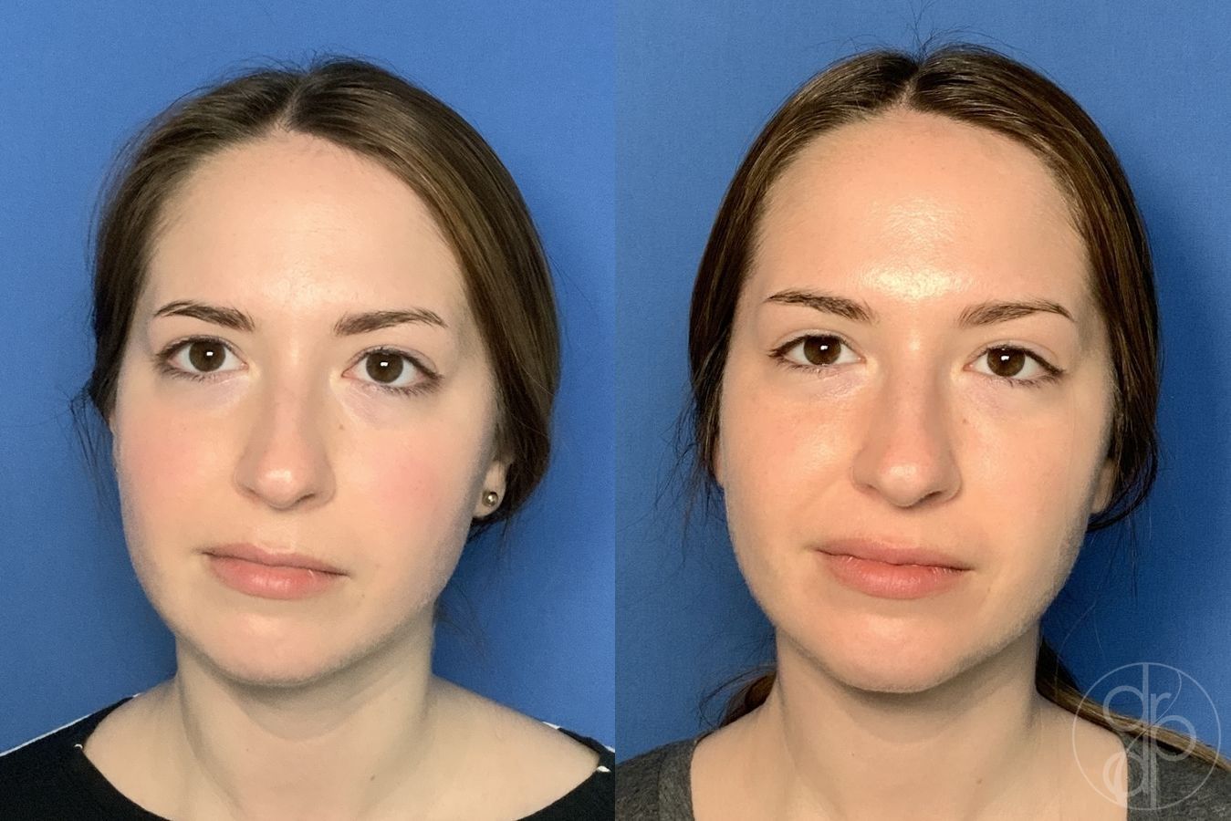 Before and after procedure result
