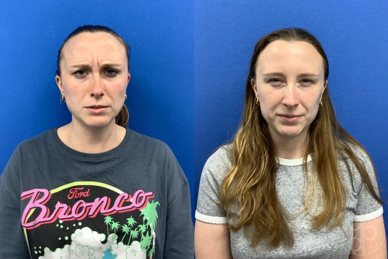 Before and after Injectables case 49449 - Angle 4