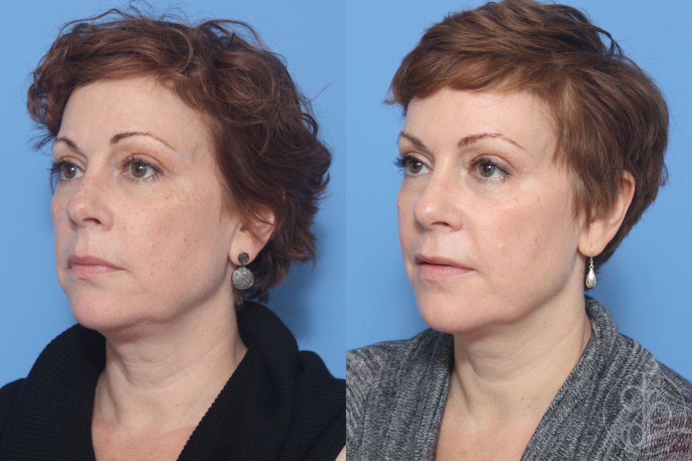 Before and after procedure result