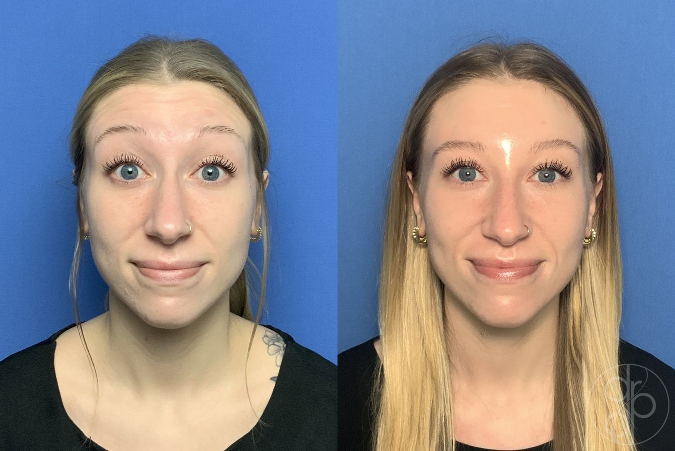 Before and after Injectables case 29980 - Angle 2