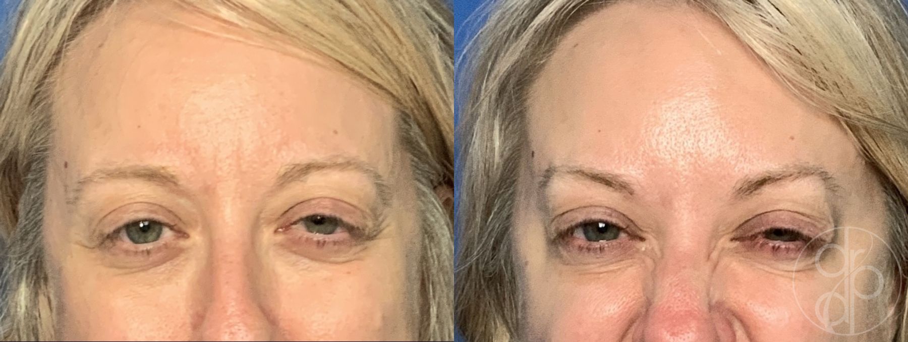 Before and after Injectables case 29963 - Angle 3