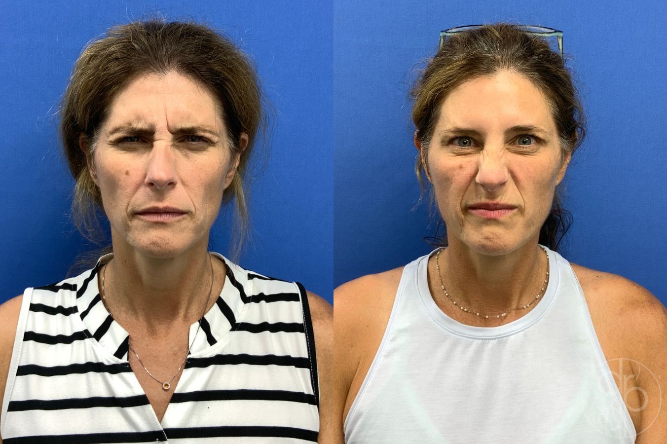 Before and after Injectables case 46747 - Angle 3