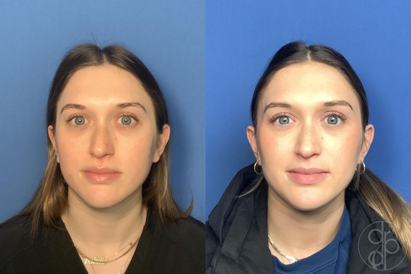 Before and after Injectables case 29984