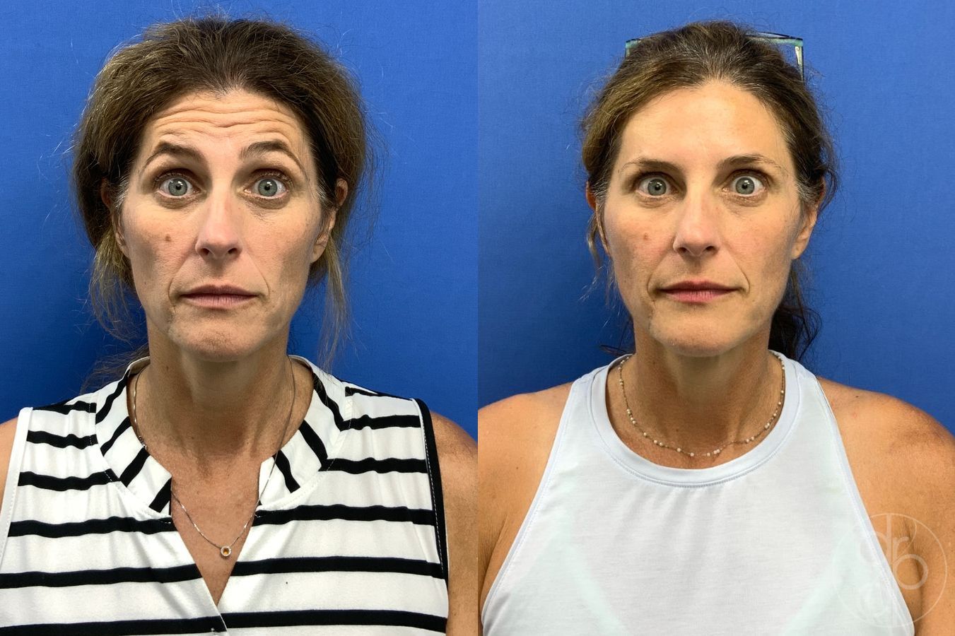 Before and after Injectables case 46747 - Angle 4