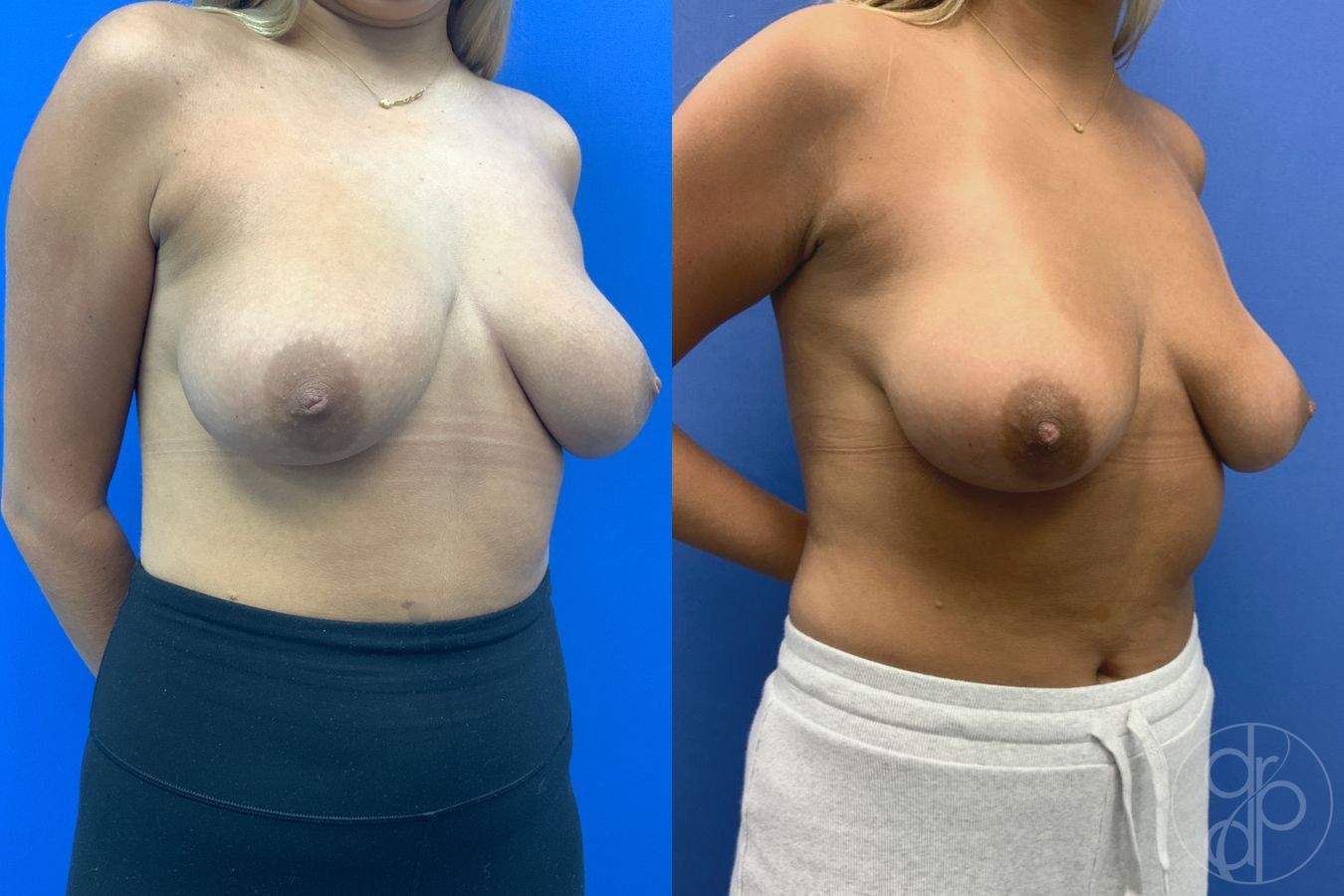 Before and after Inverted Nipple Repair case 43178 - Angle 4