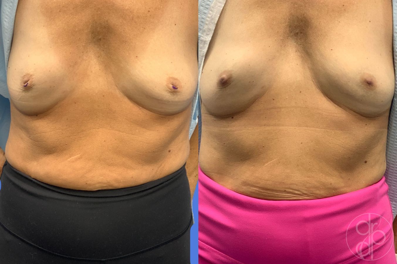 Before and after Inverted Nipple Repair case 46766