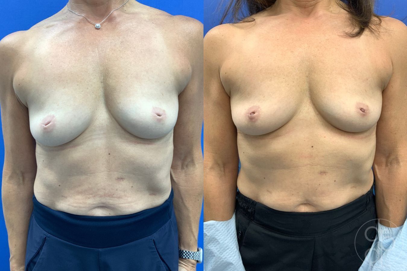 Before and after Inverted Nipple Repair case 43463