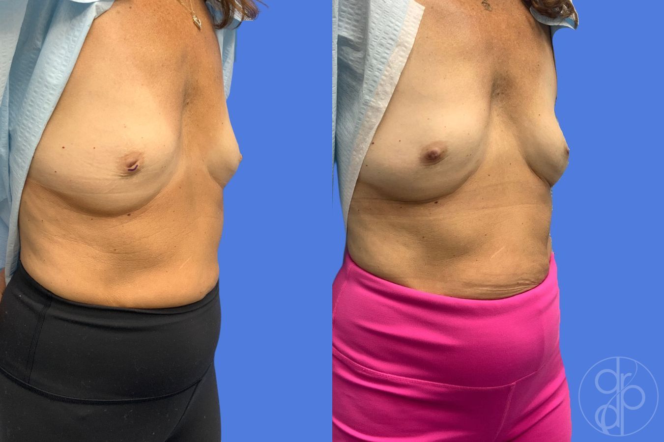 Before and after Inverted Nipple Repair case 46766 - Angle 3