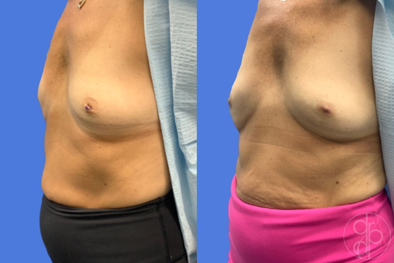 Before and after Inverted Nipple Repair case 46766 - Angle 2