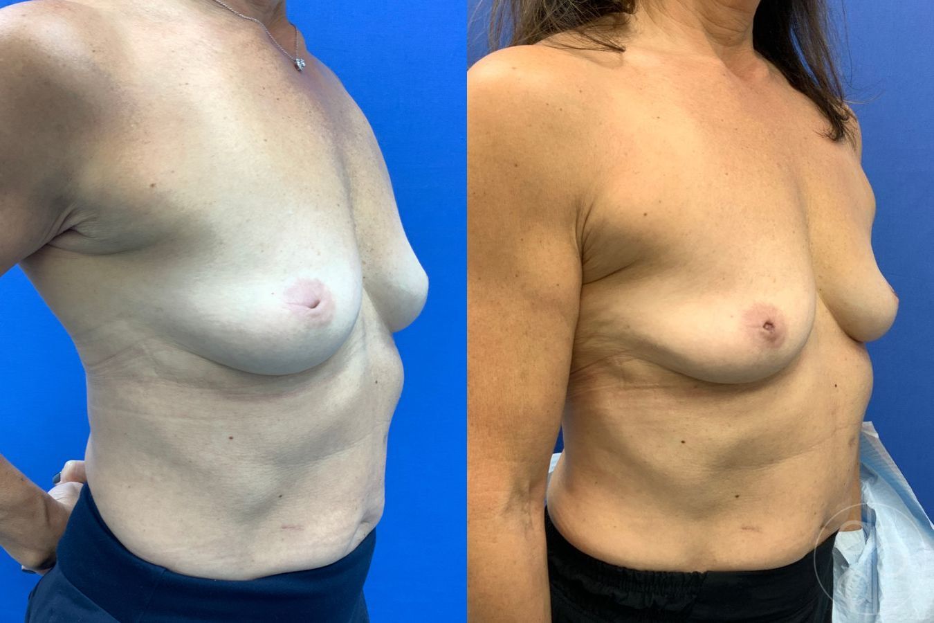 Before and after Inverted Nipple Repair case 43463 - Angle 2